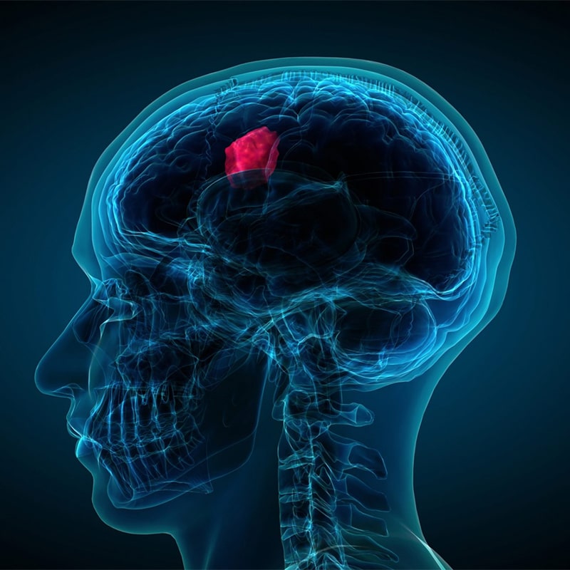Difference Between a Benign and Malignant Brain Tumor