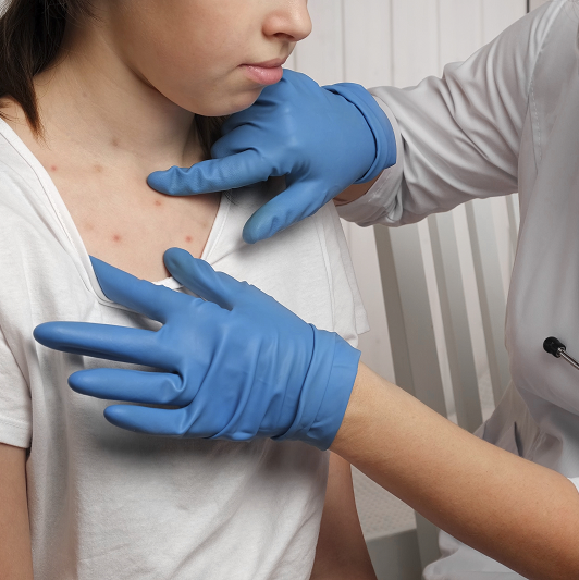 Doctor looking at the skin of a young girl with measles rashes. 
