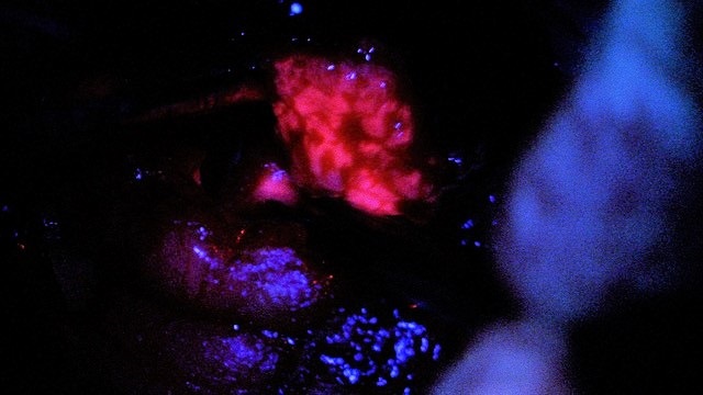 Fluorescent Guided Brain Surgery