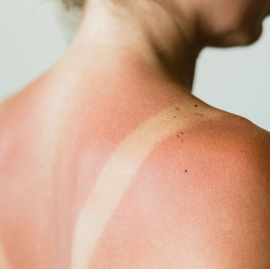 Close-up of a sunburn marks on a woman's back