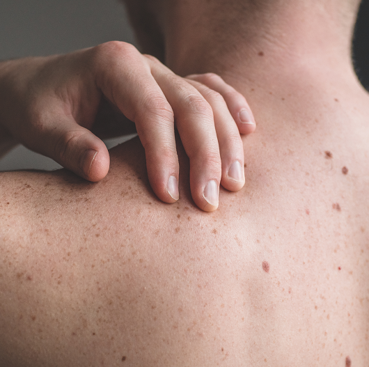 Close up detail of the bare skin on a man back with scattered moles and freckles. 