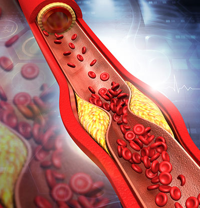 Graphic of a blocked artery. Treatment for blocked arteries.