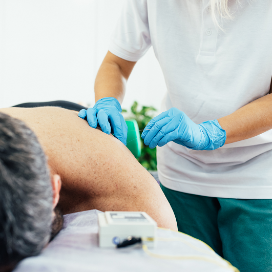 Physician administering dry needling therapy to patient laying on a table. Dry needling and cupping therapy.