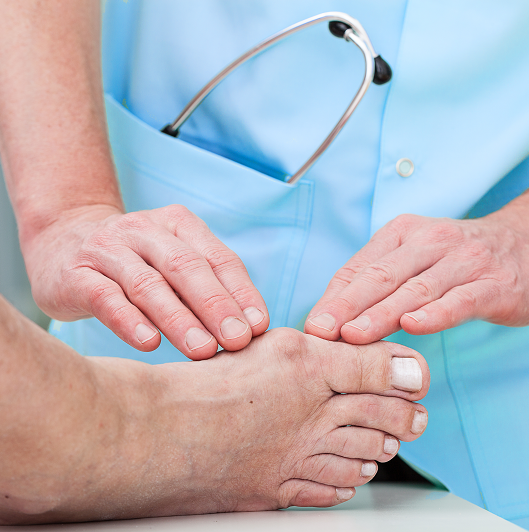 Close up view of a clinician observing a a foot with a bunion. Providing tips for bunion relief.