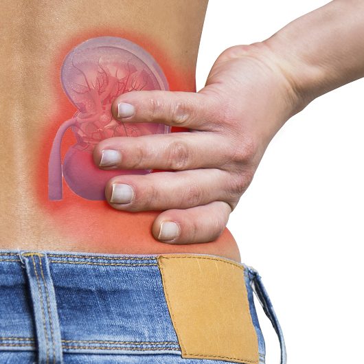 Woman clenching back for pain from kidney stones, an image of a kidney shown