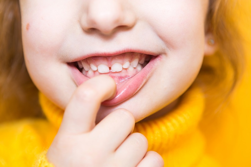 Close up, young girl shows her teeth, pulling down her bottom lip, showing her overbite.