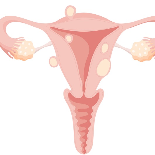 Female uterus with different types of fibroids - anatomical illustration