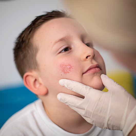 A doctor examines a rash on an adolescent boy’s face.