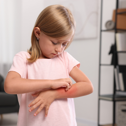Suffering from a food allergy, a little girl scratches her arm.