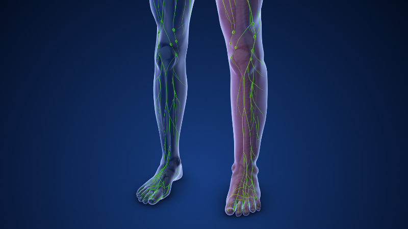 Lymphedema is a condition characterized by swelling due to the accumulation of lymph fluid in the tissues, usually in the arms or legs 