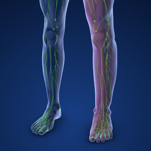 Lymphedema is a condition characterized by swelling due to the accumulation of lymph fluid in the tissues, usually in the arms or legs 