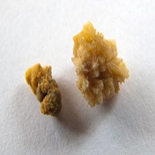 kidney stones