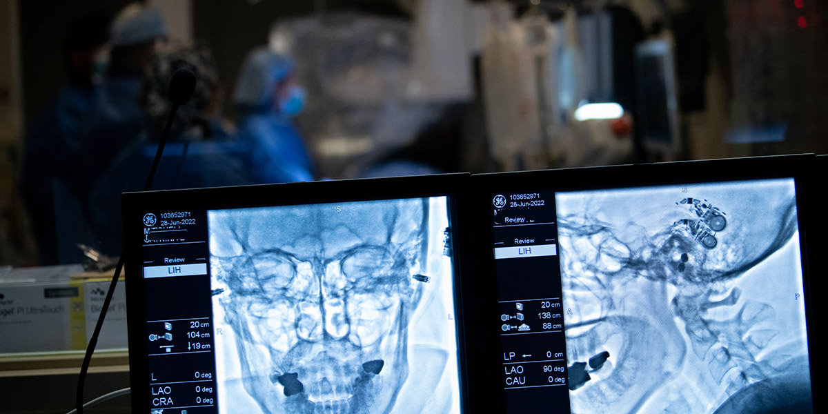 New Aneurysm Treatment