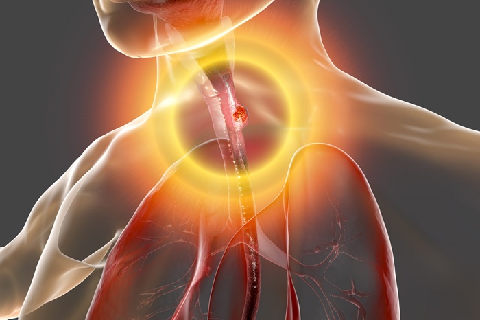 Things to know about esophageal cancer