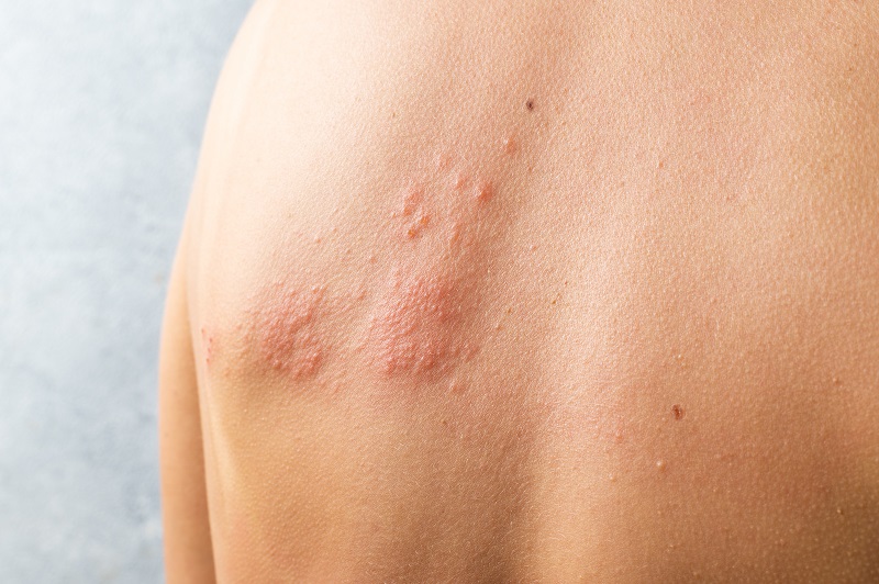 Skin infected Herpes zoster virus, shingles