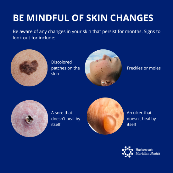 Graphic sharing skin changes to be mindful of including discoloration, freckles of moles, sores that don't heal, or ulcers that don't heal. 