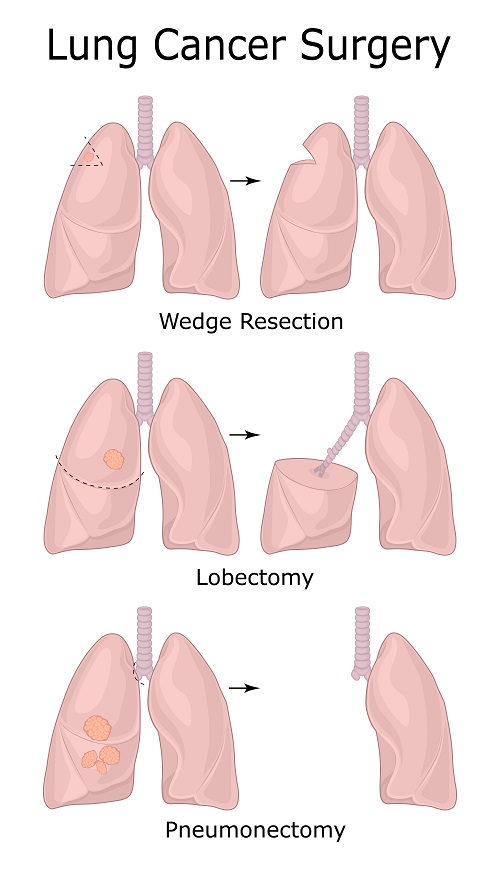 Thoracic Lung Procedures