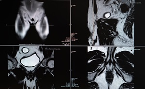 Prostate MRI