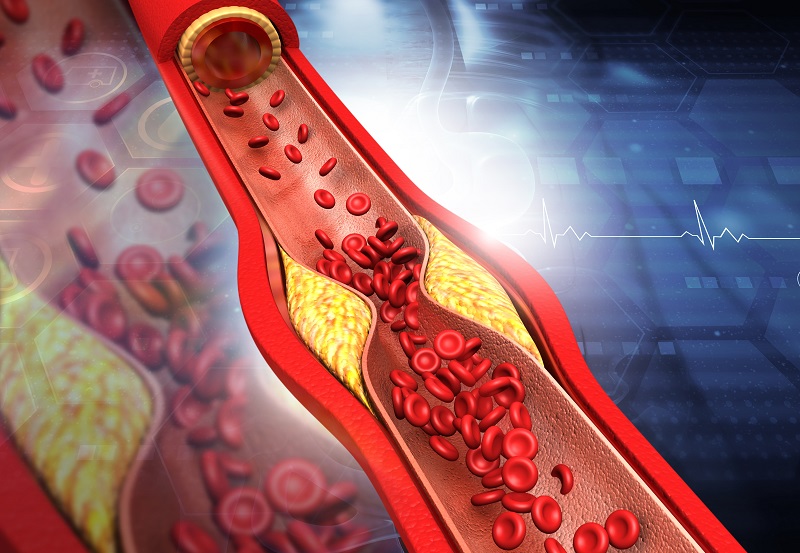 How to Clear Blocked Arteries Without Surgery 