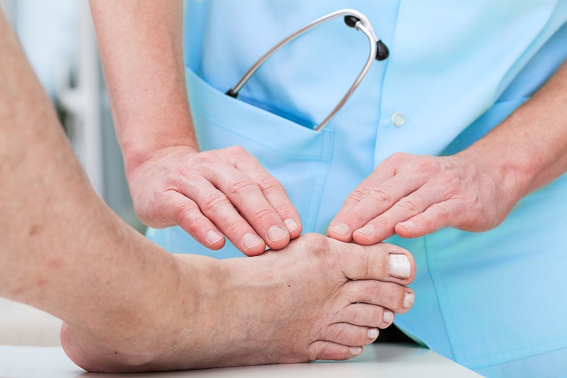 Close up view of a clinician observing a a foot with a bunion. Providing tips for bunion relief.