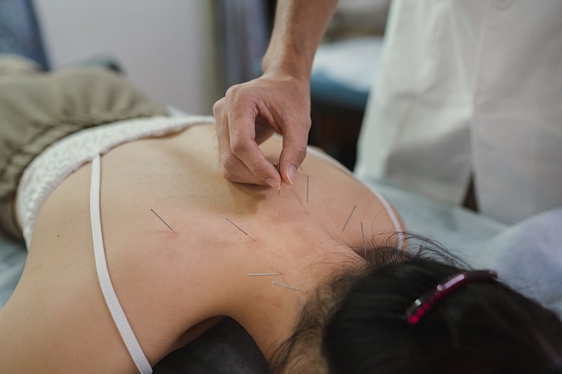 patient receiving acupuncture treatment on her back