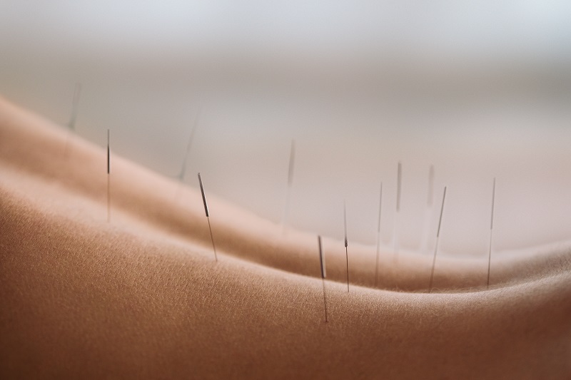 Acupuncture treatment with needles inserted into patient's back