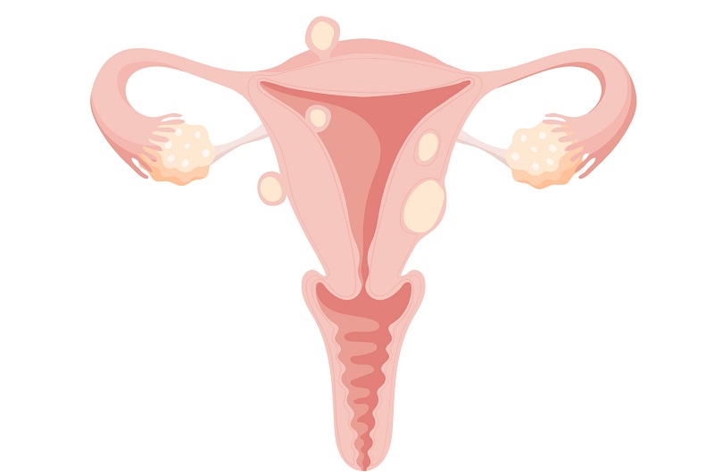 Female uterus with different types of fibroids - anatomical illustration