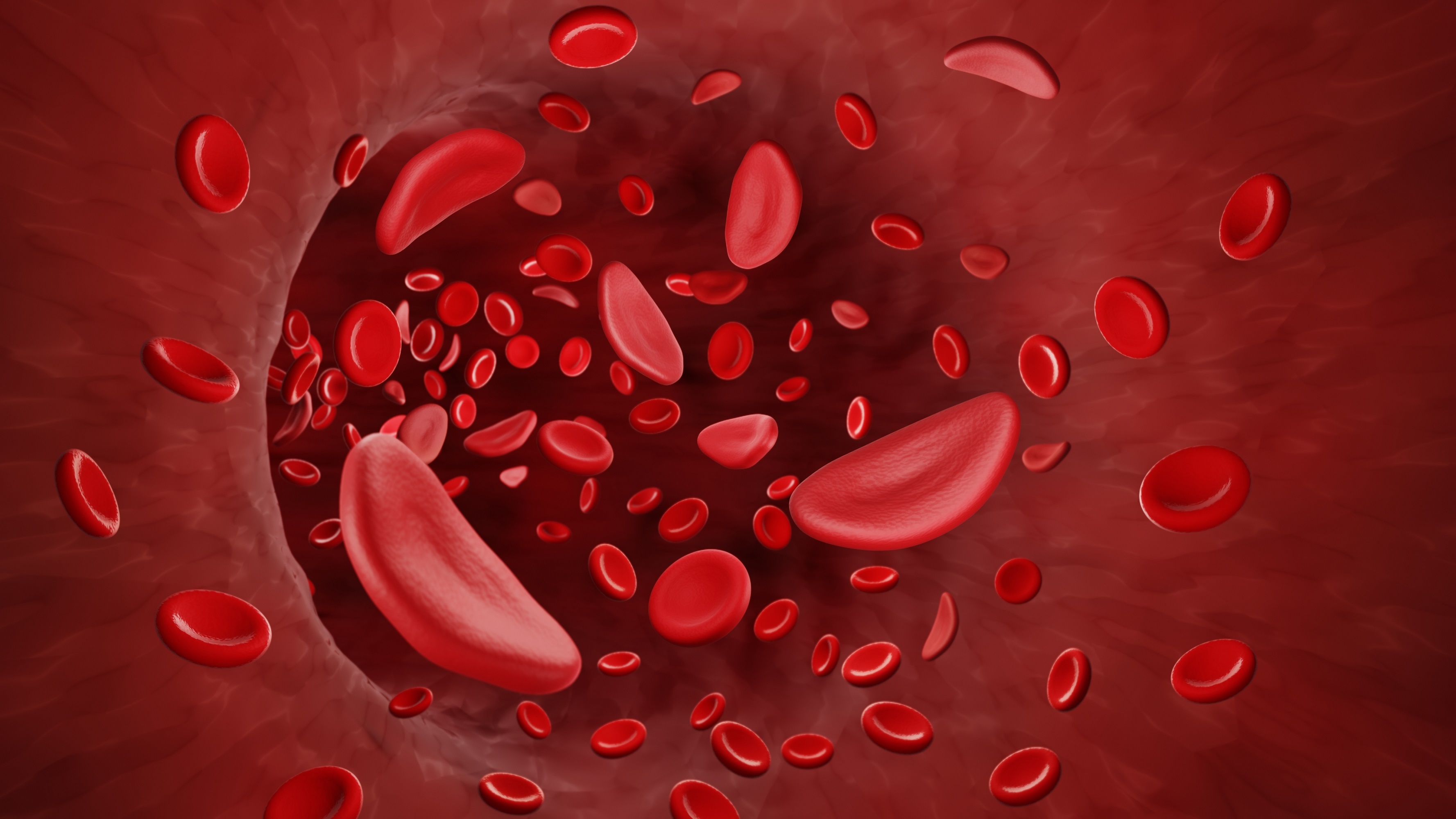 New Curative Treatment for Sickle Cell Disease