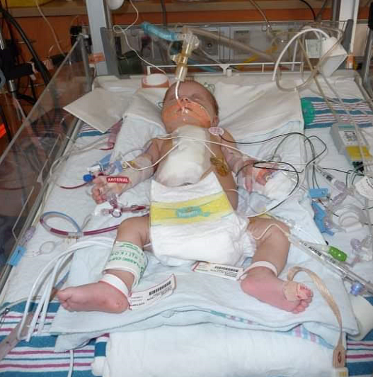 Ally Kistler as an infant in a hospital bed with tubes and wires after heart surgery