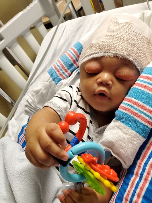 Baby Marcel head bandaged in recovery after surgery