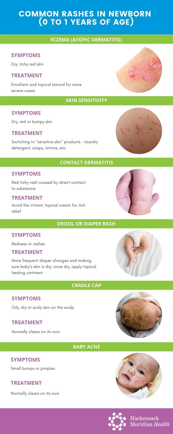 Common kid's rashes Infographic