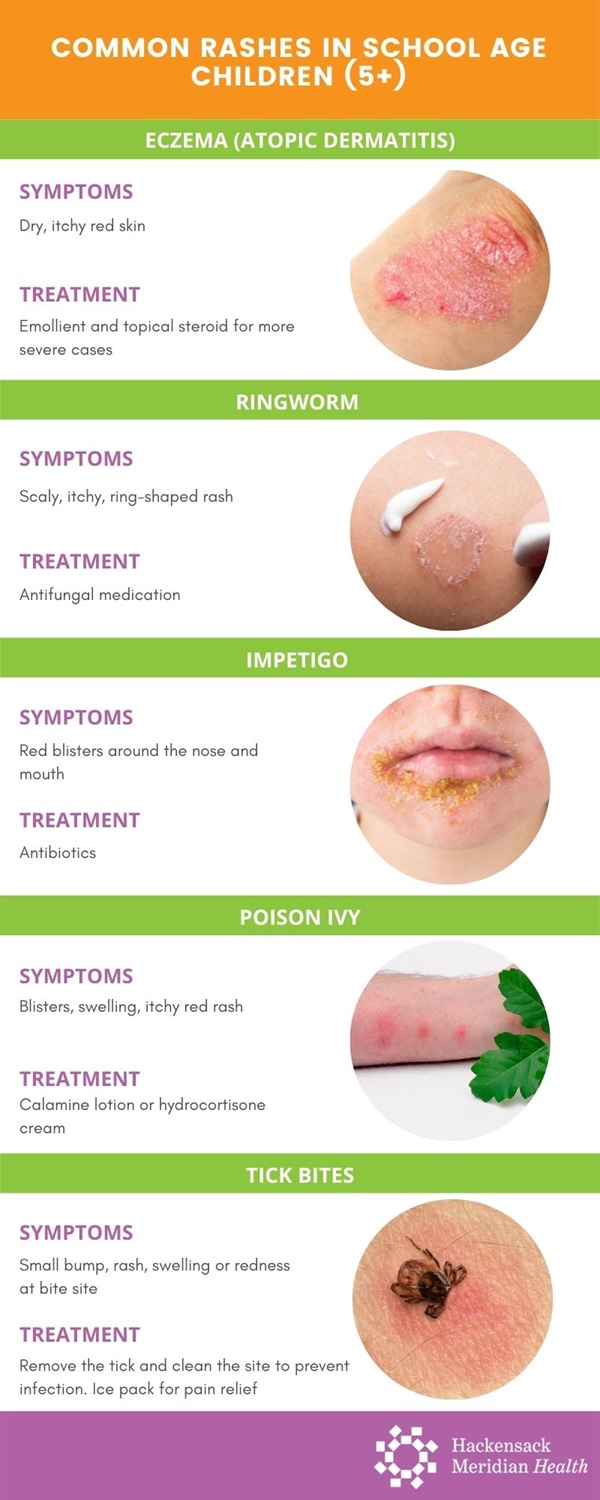 Common kid's rashes Infographic