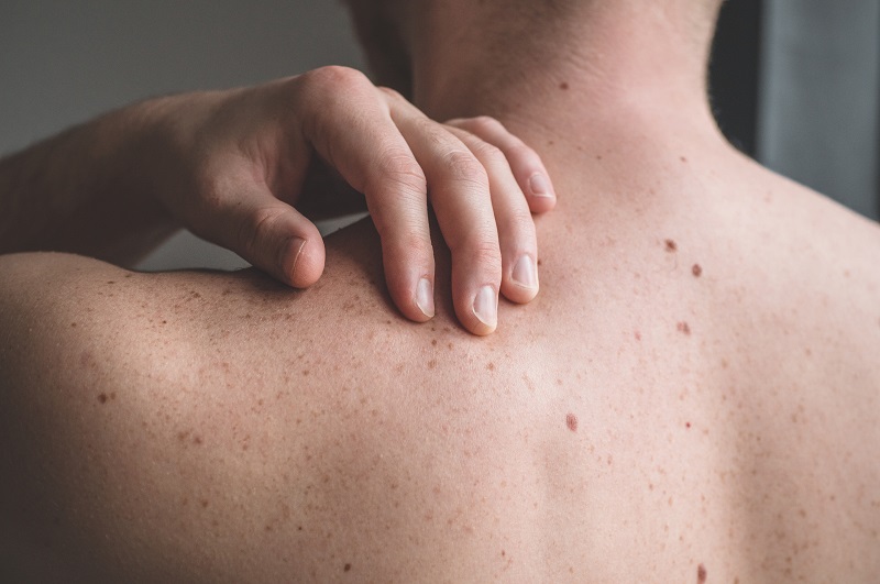 Close up detail of the bare skin on a man back with scattered moles and freckles.