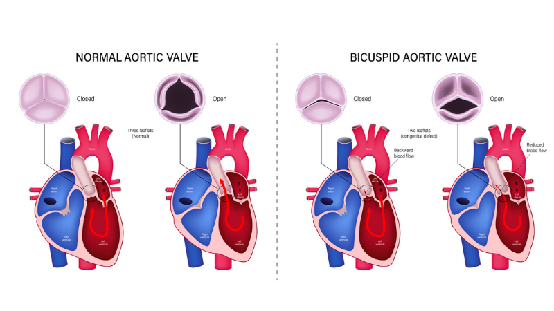 The difference of normal aortic valve and bicuspid aortic valve.
