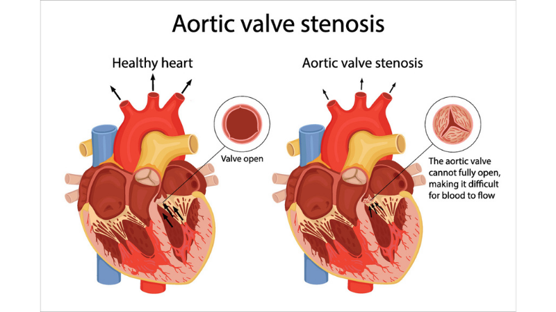 The medical illustration shows the difference between a normal aortic valve and a stenotic valve.