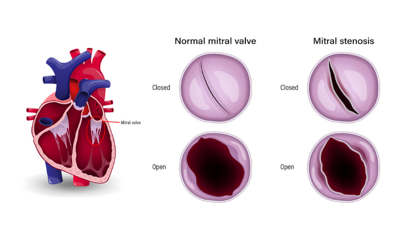 The difference of mitral stenosis and normal mitral valve.