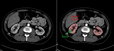 Kidney Advanced Imaging