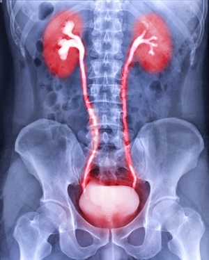 Bladder Cancer