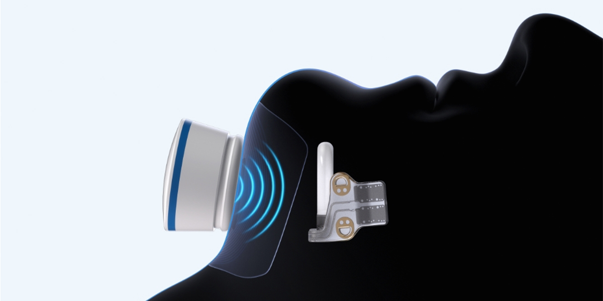 Genio Mask-Free Sleep Apnea Device
