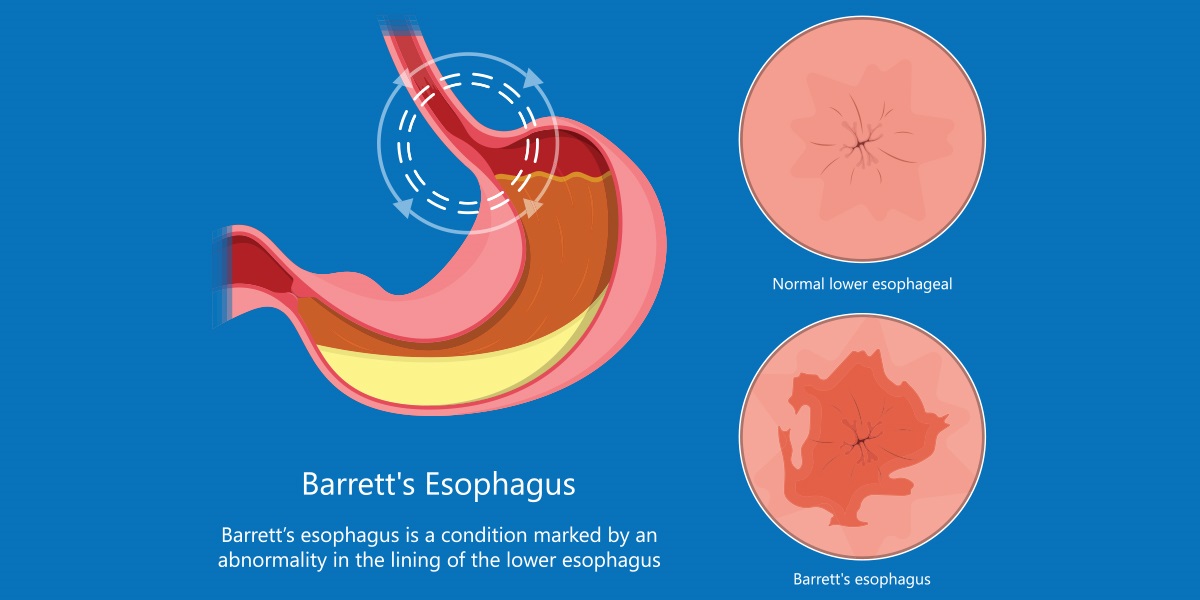 Ablation followed by aggressive screening used to manage esophageal
