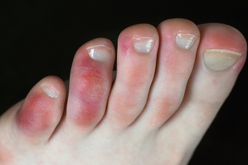 Close-up of a woman's foot with red sores, possibly COVID toes.